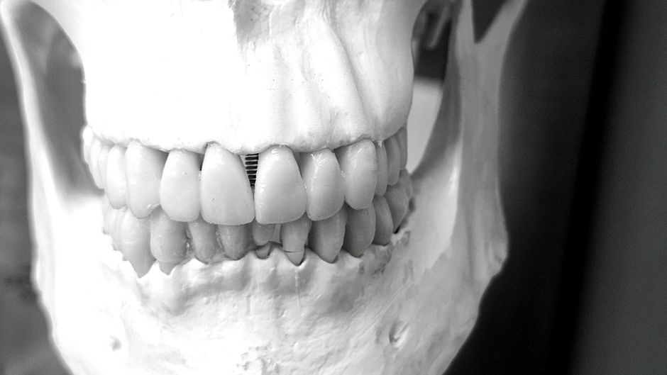 Implant dentar cand ai os insuficient: ce solutii exista