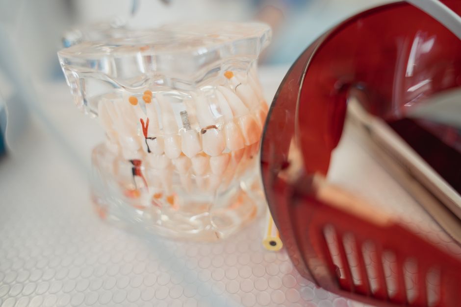 Implant dentar imediat dupa extractie: este posibil?