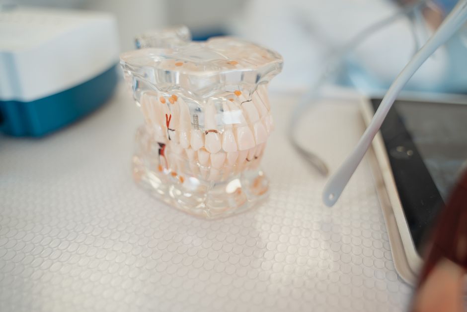 Implant dentar la varstnici: pana la ce varsta se poate
