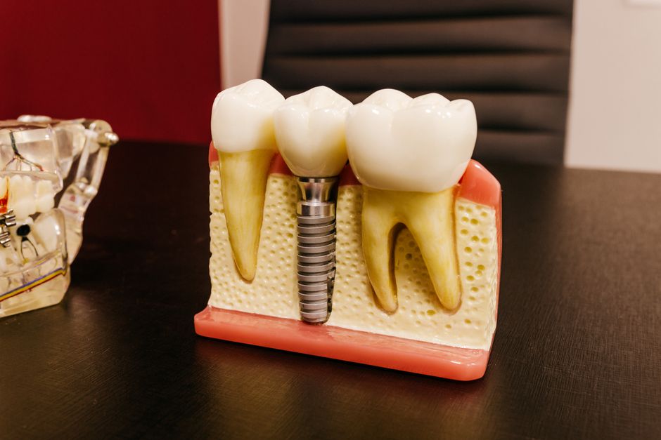 Implant dentar vs proteză mobilă: avantaje și costuri